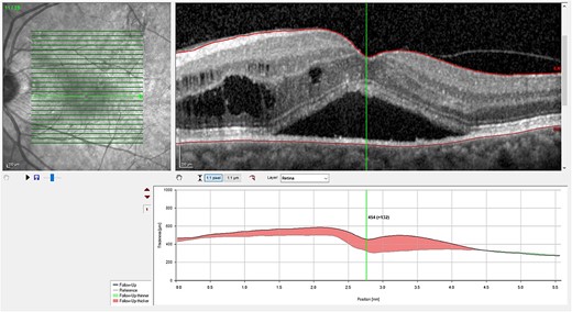 (A) OCT of left eye – IRF and SRF with serous retinal detachment. Choroidal thickness = 454 μm.