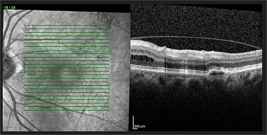 OCT of left eye – showing IRF and pigment epithelial detachment.