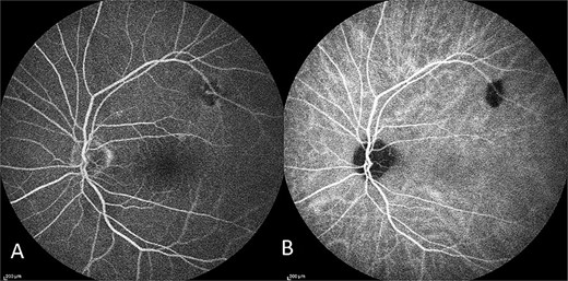 Capture of the patient’s left eye FFA (A) and ICG (B) in midphase. Hypofluorescence along the superior arcade is an area of incidental poor choroidal perfusion.