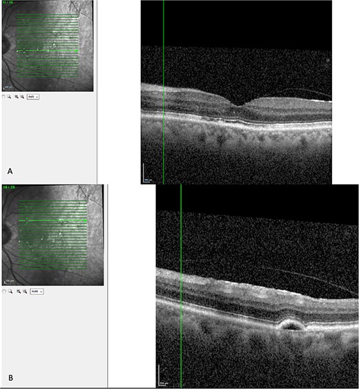 Latest OCT of the patient’s macular. (A) Shows absence of intraretinal or subretinal fluid. (B) Shows a pigmental epithelial detachment.