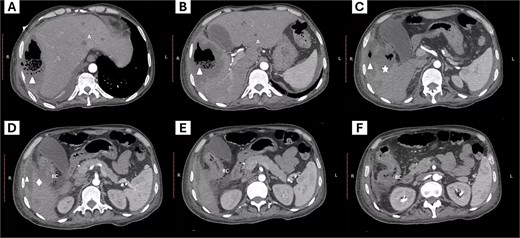 Abdominal computed tomography. The images from left to right show the cephalocaudal sequence of the tomography. (A–C) show a subphrenic abscess (triangle symbol) communicating with a hepatic abscess with compromise of the hepatic parenchyma (star symbol), and the site of colon rupture with communication to the abscess (rhombus symbol). Additionally, peripheral hepatic abscesses are visible (letter A). Images D–E show the site of communication of the colon with the abscessed region and the inflammatory process of the right colon (letters RC).