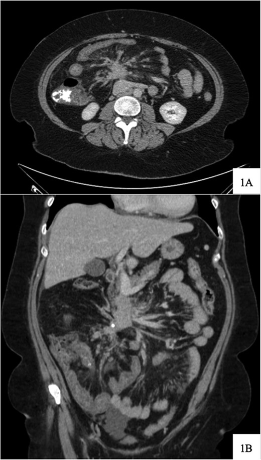 Computed tomography scan at time of diagnosis in September 2017 revealed a mass near the third portion of the duodenum and the root of the mesentery in the axial (A) and coronal (B) views.