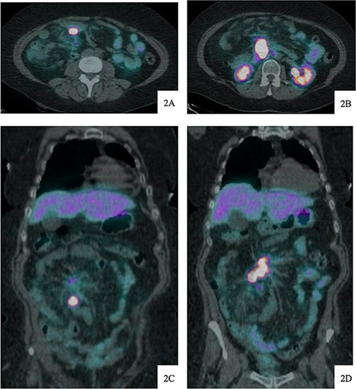 DOTATATE positron emission tomography-computed tomography scan at time of diagnosis in November 2017 revealed a small bowel primary tumor in the right lower quadrant consistent with terminal ileum (A) as well as the periduodenal mass near the root of the mesentery (B). Coronal reformatting redemonstrates the primary tumor (C) and mesenteric mass (D).