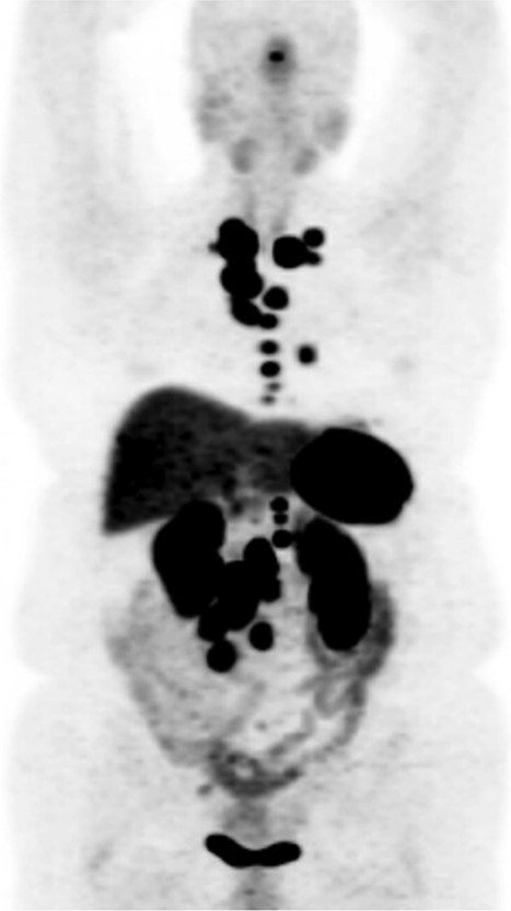 DOTATATE positron emission tomography-computed tomography scan revealing extent of metastatic disease.