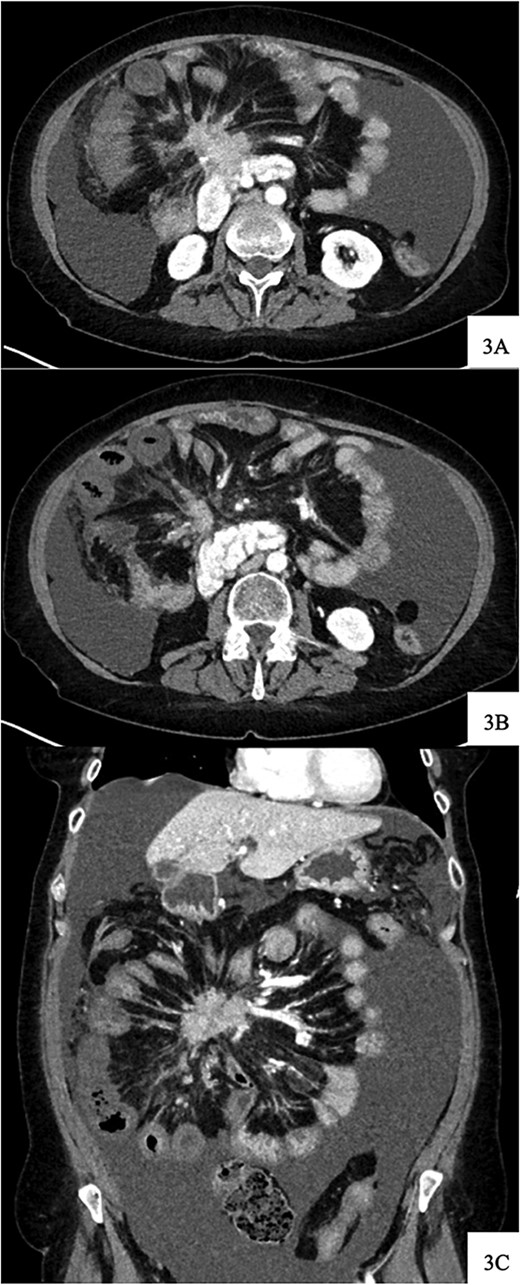 Contrast-enhanced axial CT image at time of presentation shows spiculated central mesenteric mass severe narrowing of the SMV with probably occlusion and encasement of the SMA with possible occlusion (A) associated with decreased enhancement and bowel wall thickening of several small bowel loops within the right lower quadrant (B). Coronal reformatting demonstrates the relationship of the mesenteric mass and affected small bowel (C).