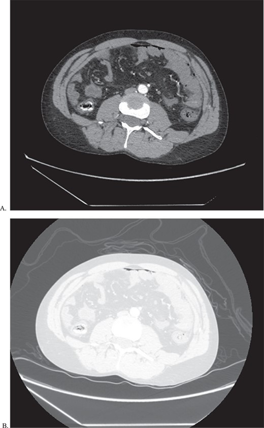CT of abdomen and pelvis in both abdominal (A) and lung (B) window to show pneumoperitoenum as well a thickened loops of bowel.