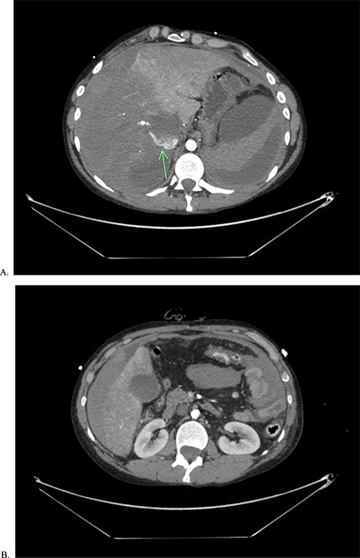 CTA of abdomen and pelvis showing the large contrast extravasation (A) as well as significant amount of free fluid in the abdomen (B).
