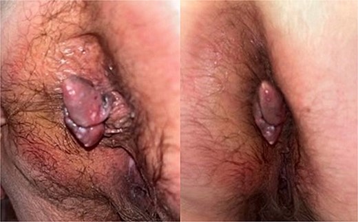 Images of anal melanoma on physical exam pre-surgical excision.
