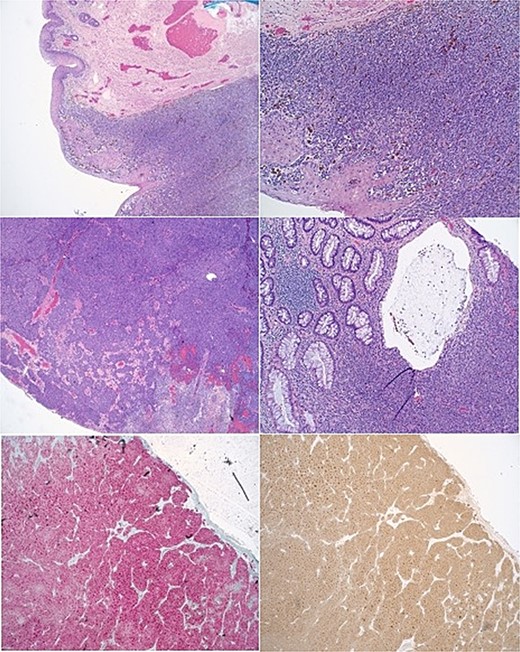 Histopathological slides of anal mass showing anal melanoma.