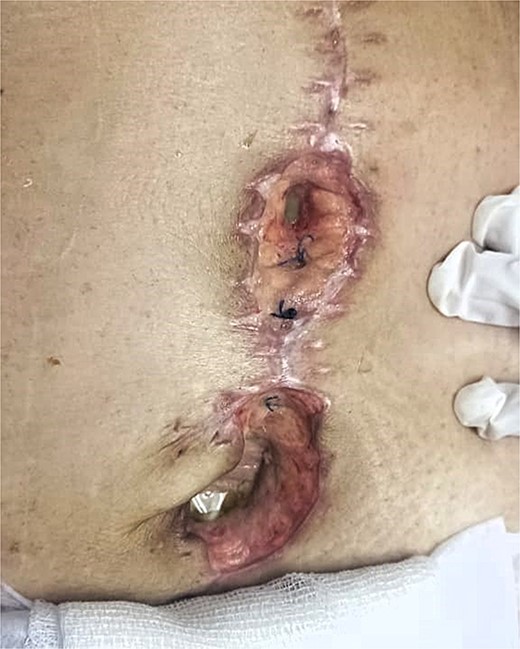 Dehiscence of abdominal surgical wound, inside view of infected aponeurotic layer with purulent exudate from the inferior border of the wound.
