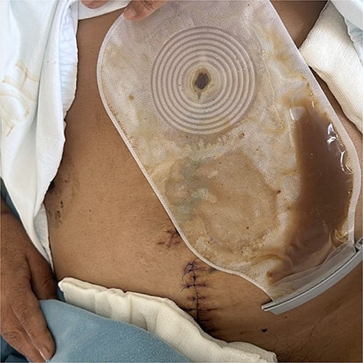 Cutaneous pancreatic fistula with abundant purulent-brownish exudate from midline laparotomy wound.