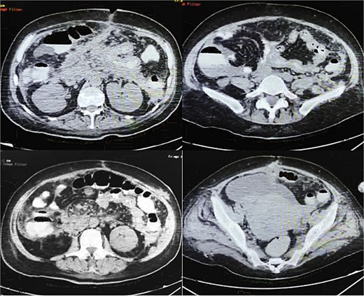 Oral contrasted abdominal CT with presence of abundant pancreatic collections on body and tail of pancreas with a volume of 132 ml, with evident fistulous tract from pancreatic parenchyma to abdominal fat and muscles near the surgical wound, torsion of mesenteric fat and vessels and terminal ileum loops in right abdominal space, free abdominal fluid on pelvic space.