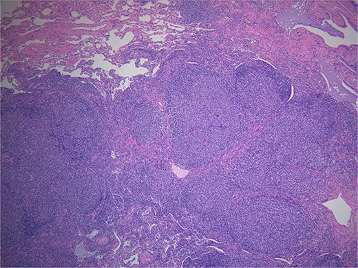 Hematoxylin and eosin. Demonstrates back to back neoplastic follicles within lung tissue.