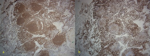 (a) 4×-Immunostain for CD20 highlights B-cells in neoplastic follicles. (b) CD3 highlights reactive T-cells around neoplastic follicles.
