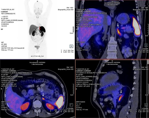 PET-SCAN with gadotatate study with the tumor capitation evidence (arrows).
