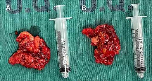 Left compound pheochromocytoma with neuroblastoma in differentiation.