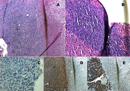 Histopathology images. (A) HE 4×: Compound pheochromocytoma (*). (B) Neuroblastoma in differentiation (*). (C) Ki67 proliferation index of 1% in the adrenal medullary area (*). (D) Immunohistochemistry with cytoplasmic chromogranin positivity (*). (E) Immunohistochemistry with cytoplasmic synaptophysin positivity (*).