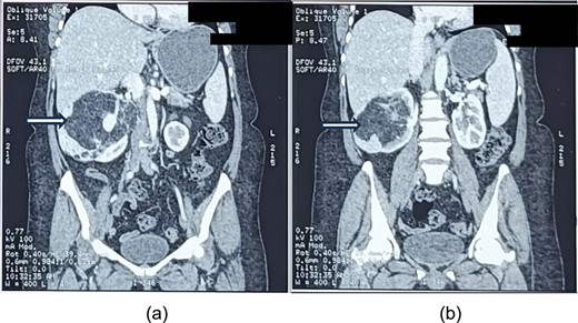 a and b showing abdominal CT scan cuts, showing mixed density mass arising from the right kidney (white arrows).