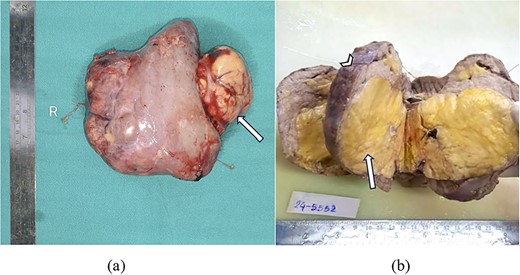 (a) Gross resected nephrectomy specimen showing tumour fat extrusion breaching renal hilum (arrow). (b) Cut section of nephrectomy specimen showing yellow to tan tumour areas (arrow) replacing entire renal parenchyma (arrowhead).