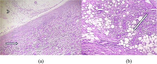 (a) H&E × 40 section shows tumour area (arrowhead) consisting of adipose tissue with compressed glomeruli and tubules (short arrow). (b) H&E × 100 section shows mature adipose tissue (long arrow) along with haphazardly arranged smooth muscle fibres and infiltrated by dense inflammatory cells.