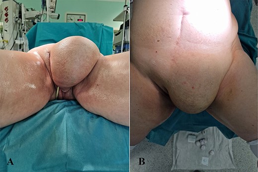 Clinical appearance of the hernia (A – view from below, B – frontal view).