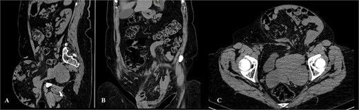 Computerized tomography of the abdomen (A – sagittal scan, B – coronal scan, C – axial scan).