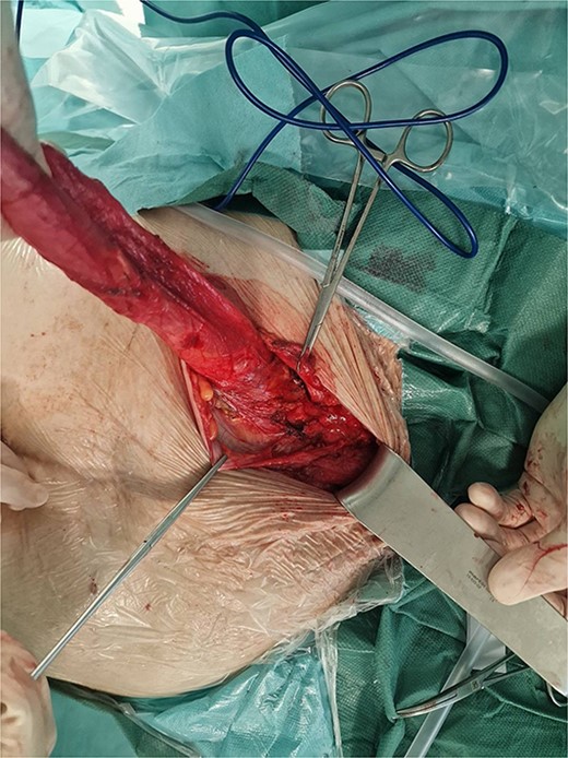 Intraoperative photo of dissected hernia sac.
