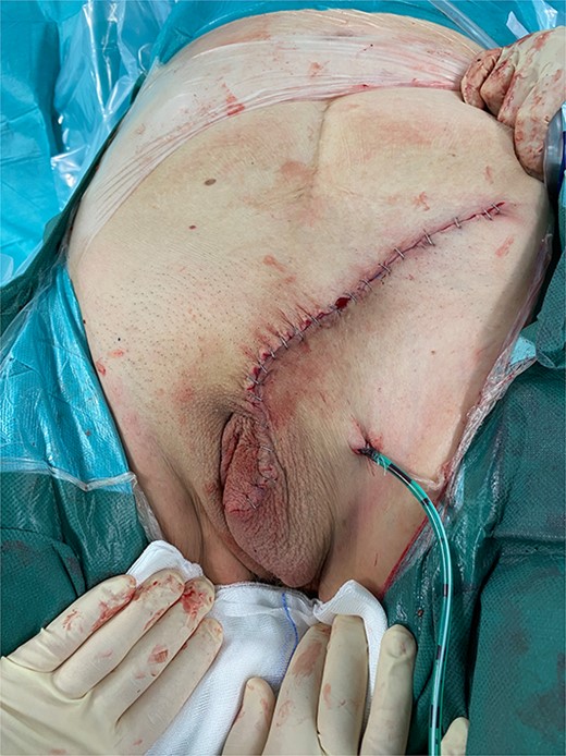 Final intraoperative photo with a drain in place.