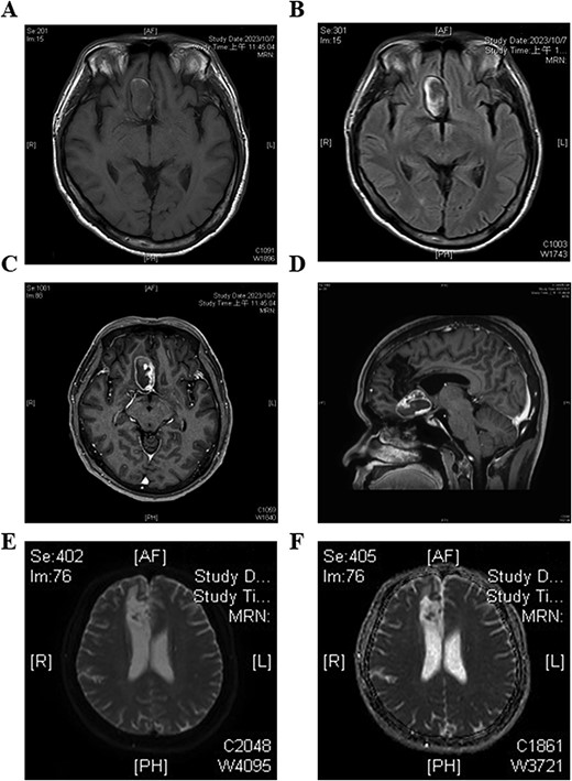 Preoperative brain magnetic resonance imaging (MRI) of the patient reveals a giant aneurysm in the right frontal area. (A) T1-weighted image shows the mass as hypointense. (B) T2-FLAIR image shows hypointensity in the center with peripheral hyperintensity. (C, D) Contrast-enhanced T1 images demonstrate peripheral contrast stasis around the mass, with no enhancement observed in the distal right anterior cerebral artery (ACA). (E, F) Diffusion-weighted image (DWI) and apparent diffusion coefficient (ADC) images show infarction in the areas supplied by the right distal ACA.