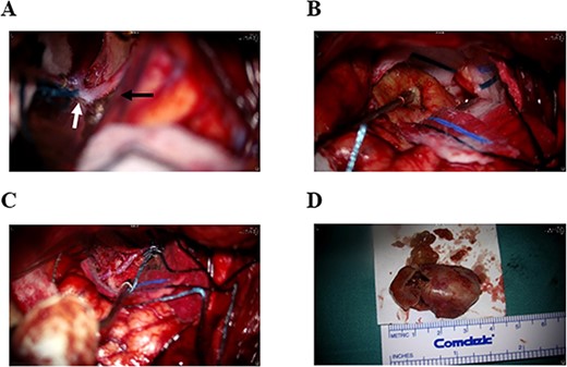 Intra-operative images. (A) The right A1 segment (black arrow) and anterior communicating artery (white arrow) are patent. (B) The giant aneurysm is completely occluded, showing no arterial flow. (C) The aneurysm clip is applied to the right A2 segment of the ACA before resection of the aneurysm. (D) The fully resected giant aneurysm measures ~4 cm in size.