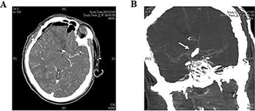Postoperative brain computed tomography angiography. (A) No immediate signs of intracerebral hemorrhage or epidural hematoma are observed. (B) The patency of the A1 segment (white arrow) of the ACA is confirmed.