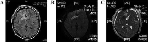 Postoperative brain MRI. (A) T2-weighted image shows a hyperintense area, indicating acute infarction of the recurrent artery of Heubner. (B, C) Findings are consistent with the abnormalities observed on the DWI and ADC images, respectively.