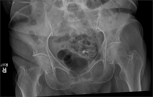Abdominal X-ray of plastic biliary stent overlying the pelvis.