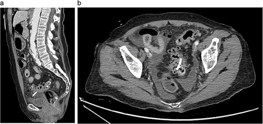 Abdominal CT showing migrated biliary stent that perforates the sigmoid colon in the sagittal (a) and axial (b) views. Pneumoperitoneum and free fluid in the pelvis are also noted.