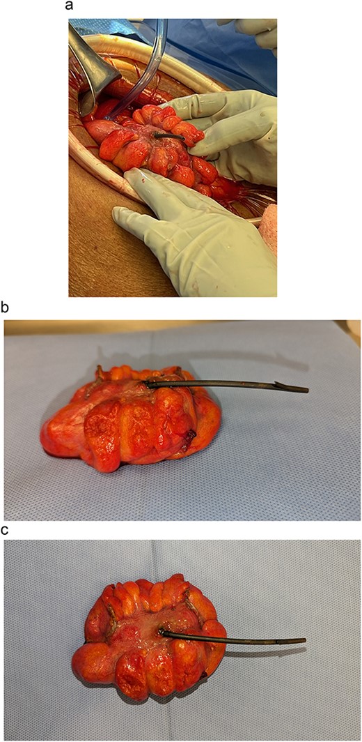 Migrated biliary stent perforating through a portion of sigmoid colon (a) intraoperatively and (b, c) post-resection.
