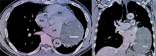 CT angiography demonstrating a huge tumor (8.9 × 7.3 × 12.2 cm) measuring adjacent to the left atrium (LA) and left ventricle (LV). Ao, ascending aorta; RA, right atrium; RV, right ventricle; PA, pulmonary artery.