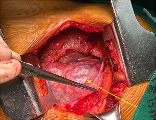 Operative findings. The schwannoma (arrow) was seen from the left thoracotomy when opening the pericardium.