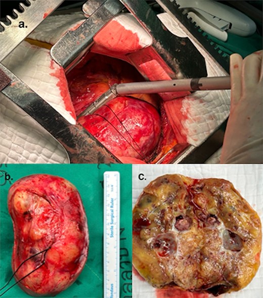 (a) Resected schwannoma with an Endo GIA stapler. (b) Resected giant cardiac schwannoma (12 × 7 cm). (c) Macro findings of the tumor showing a cystic structure with wall thickening.
