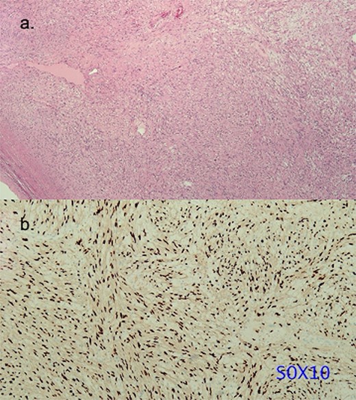 Histopathology of the resected schwannoma. (a) Histologic analysis of the specimen revealing alternative cell-rich Antoni A type area and cell-poor Antoni B type area (hematoxylin and eosin stain). The resected specimen did not show pathological continuity between the left atrium and the tumor. (b) Tumor cells exhibiting intense positive staining for S-100 protein.
