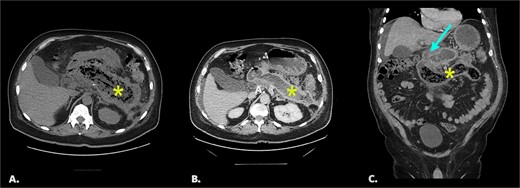 (A) Initial non-contrast CT. Axial image shows extensive pancreatic necrosis and phlegmon (*). 1B/C Follow up CT with IV contrast (portal venous phase). Image 1B: axial image shows fluid replacement of tissue in the pancreatic bed (*). Image IC: coronal image shows fistula between pancreatic bed and duodenum (arrow) and bezoar in the distal duodenum (*).