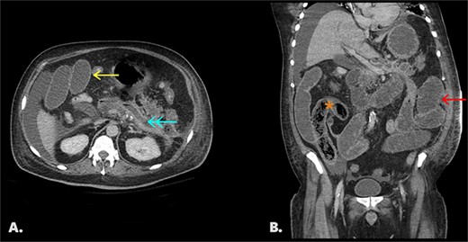 Follow-up CT with IV contrast (portal venous phase). Fig. 2A: an axial image shows a collapsed pancreatic bed (↞) containing trace fluid, dilated small bowel loops (←), and perihepatic free fluid. Fig. 2B: coronal image of same study shows interval migration of the bezoar into the distal small bowel (*) and upstream dilated, fluid-filled small bowel (←).