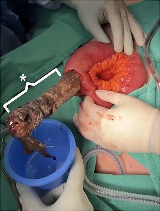 Intraoperative findings.