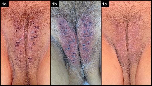 Multiple angiokeratomas on the labia majora of the vulva (a), immediately following the procedure (b), and at 14 days follow-up visit (c).