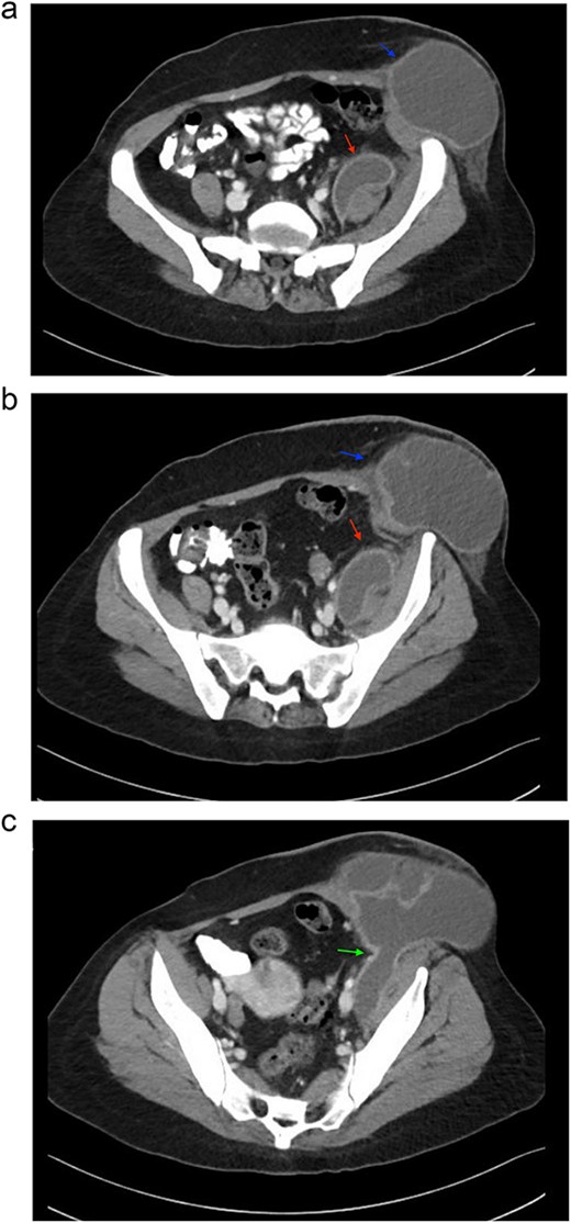 Sequential images of CT with contrast of the abdomen and pelvis demonstrating the pathology. (a) Slice 96—a small fluid collection in the left psoas muscle (lower arrow), and a low-density fluid collection in the left inguinal region (upper arrow), both with wall enhancement, consistent with abscess formation. (b) Slice 102—progression and enlargement of the iliopsoas (lower arrow) and inguinal (upper arrow) abscesses. (c) Slice 110—connection between the iliopsoas and inguinal abscesses, indicating advanced spread of infection (arrow).