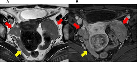 Imaging studies of pelvic magnetic resonance imaging (MRI). (a) Axial T2-weighted (T2WI) MRI, (b) axial contrast-enhanced T1-weighted (T1WI) MRI. The red arrows indicate bilateral ovarian tumors. The yellow arrows indicate pelvic dissemination. Bilateral ovarian masses exhibited a mildly hyperintense signal on T2WI and an isointense signal with the myometrium on T1WI. Both masses have a smooth surface and a homogeneous internal structure.