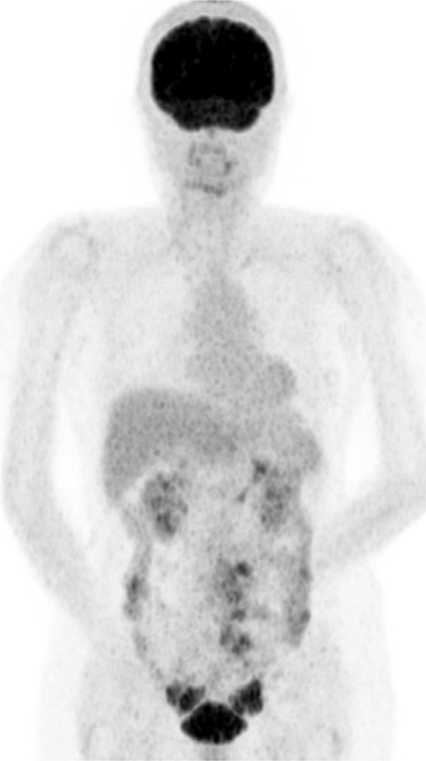 Positron emission tomography (PET-CT) scan showing FDG uptake in the ovaries and mesentery.