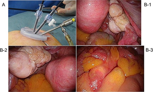 Intra-abdominal findings: (a) right ovary, (b) left ovary, and (c) multiple enlarged lymph nodes in the mesentery, findings inconsistent with epithelial ovarian tumors.