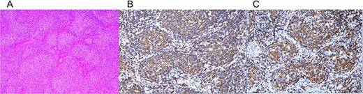 Pathological and immunohistochemical findings: (a) hematoxylin and eosin (HE), (b) CD20, and (c) CD79. (a) HE staining reveals nodular lymphocytic proliferation replacing the entire ovary, with monotonous proliferation of medium-sized lymphocytes resembling centrocytes. (b, c) Immunohistochemistry reveals CD20 and positivity. Plasmacytoid cells forming the nodules tested positive for CD20, CD79α, CD10, and Bcl-2, indicating a B-cell lineage. Dendritic cells expressing CD21 and CD23 were distributed within the nodules.