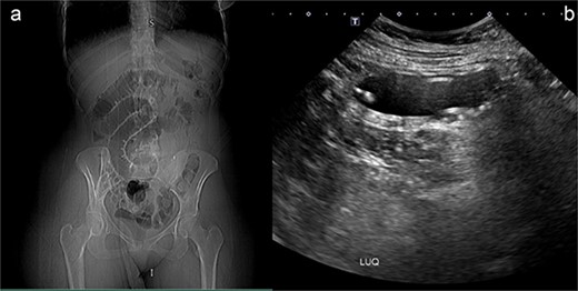 (a) Plan X-ray abdomen showing dilated jejunal loops. (b) Abdominal US showing small bowel containing IGB.