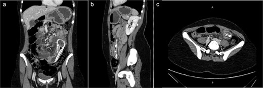 (a) Coronal view (b) sagittal view (c) axial view of the abdominal CT scan with oral water-soluble contrast showing IGB migrated and impacted in the jejunum with the proximal SBO.